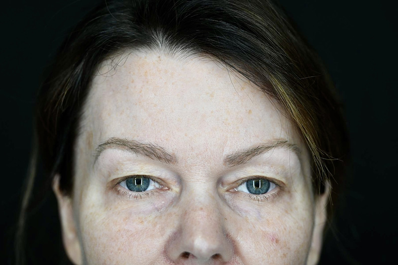 Blepharoplasty Before & After Image