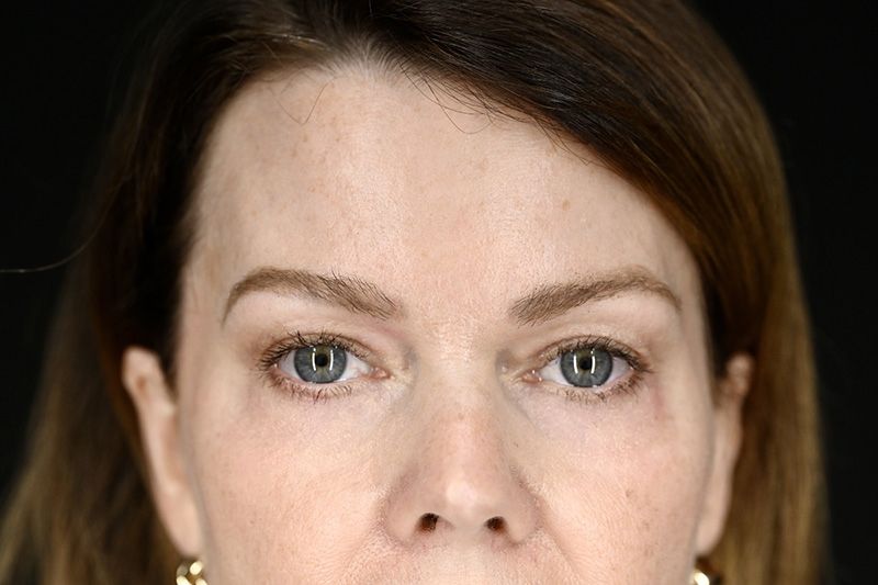 Blepharoplasty Before & After Image