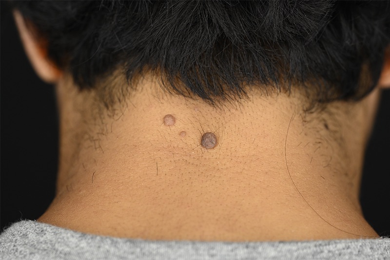 Mole Removal Before & After Image