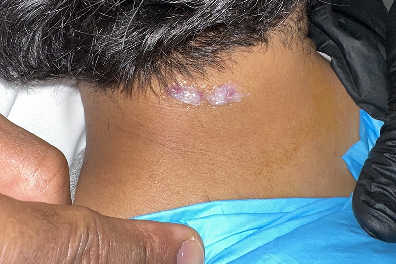 Mole Removal Before & After Image