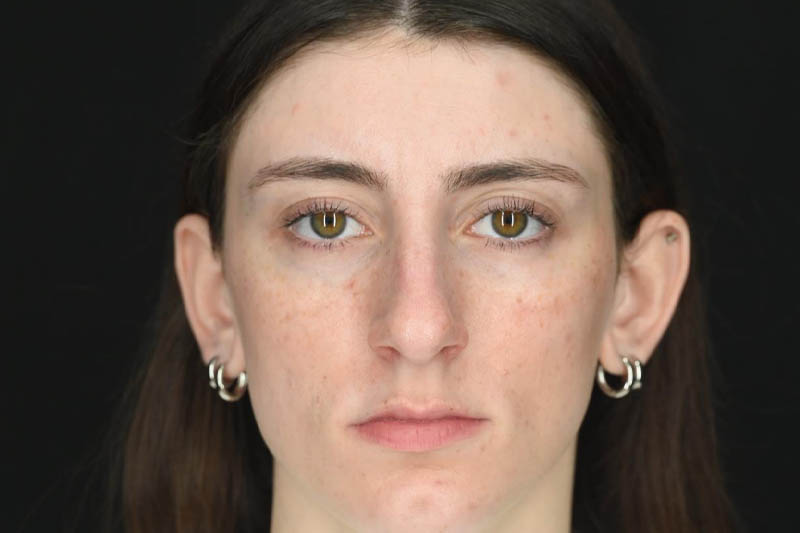 1_0000_Rhinoplasty 01 Before View 1.jpeg