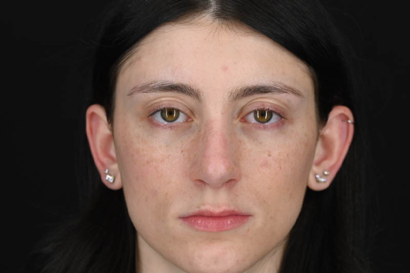 1_0001_Rhinoplasty 01 After View 1.png