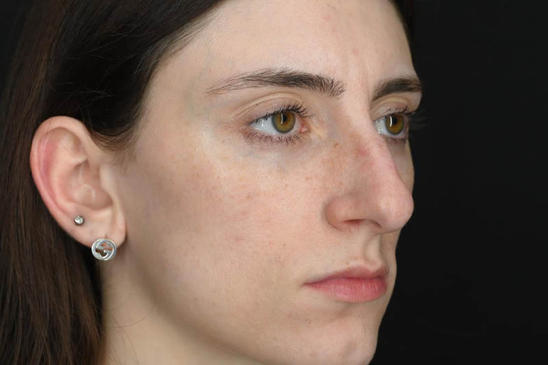 1_0002_Rhinoplasty 01 Before View 2.jpeg