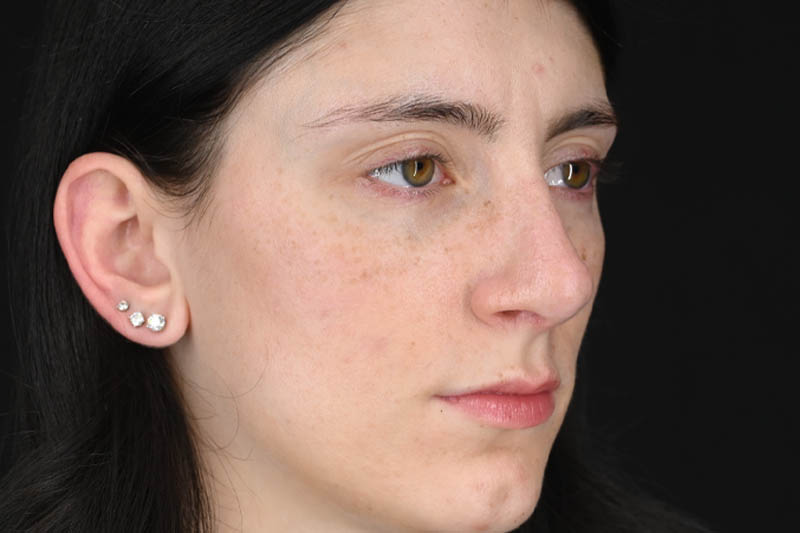 1_0003_Rhinoplasty 01 After View 2.png