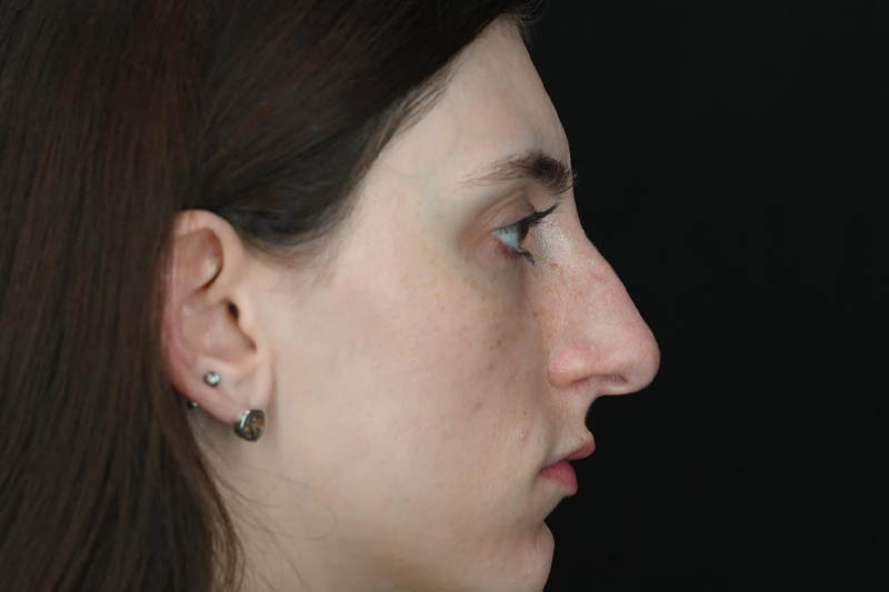 1_0004_Rhinoplasty 01 Before View 3.jpeg