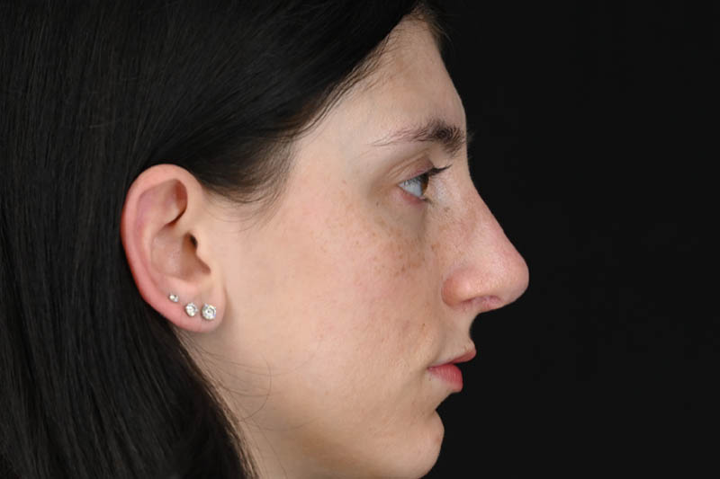 1_0005_Rhinoplasty 01 After View 3.png