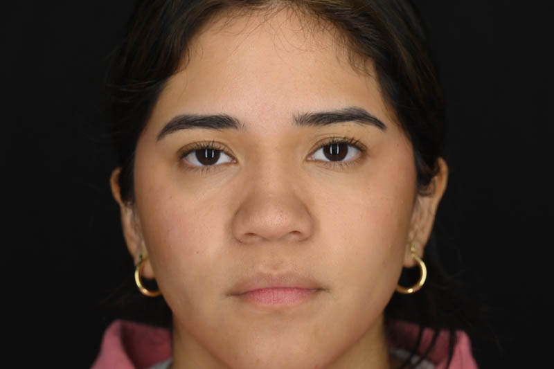 1_0006_Rhinoplasty 02 Before View 1.png