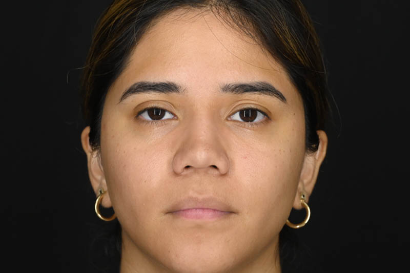 1_0007_Rhinoplasty 02 After View 1.png