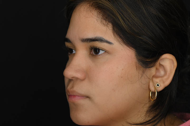 1_0008_Rhinoplasty 02 Before View 2.png