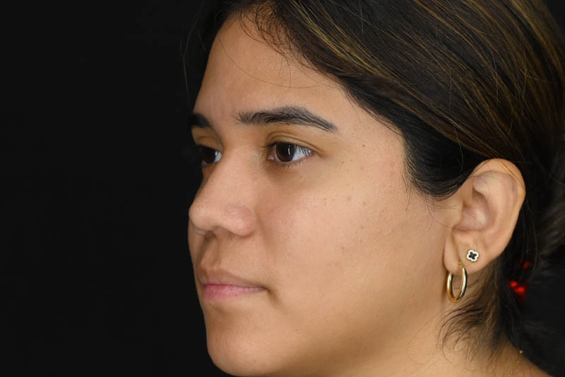 1_0009_Rhinoplasty 02 After View 2.png