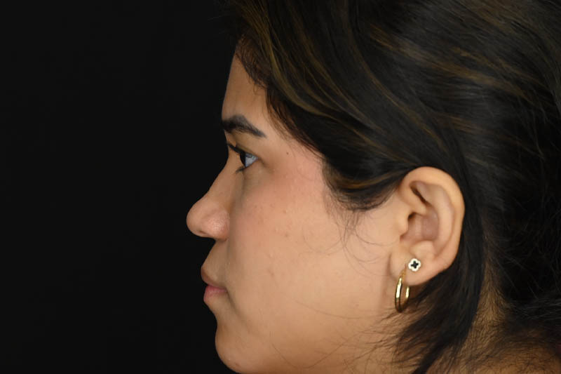 1_0010_Rhinoplasty 02 Before View 3.png