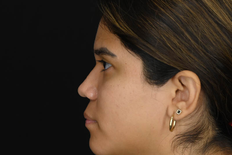 1_0011_Rhinoplasty 02 After View 3.png