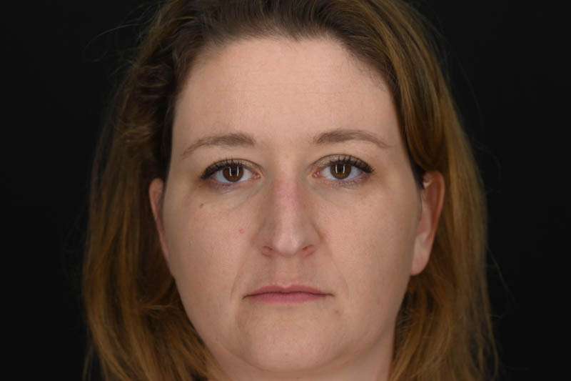 1_0012_Rhinoplasty 03 Before View 1 .jpeg