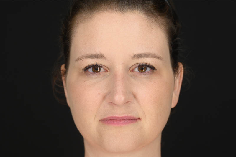 1_0013_Rhinoplasty 03 After View 1.png