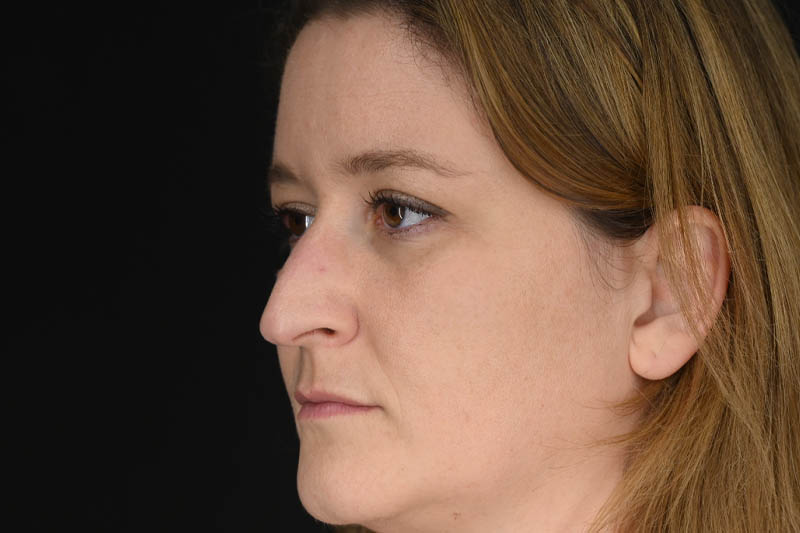 1_0014_Rhinoplasty 03 Before View 2.png