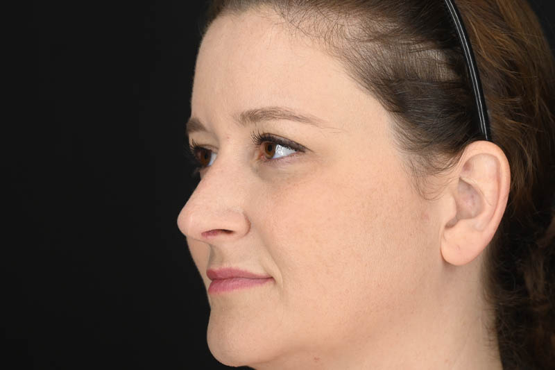 1_0015_Rhinoplasty 03 After View 2.png