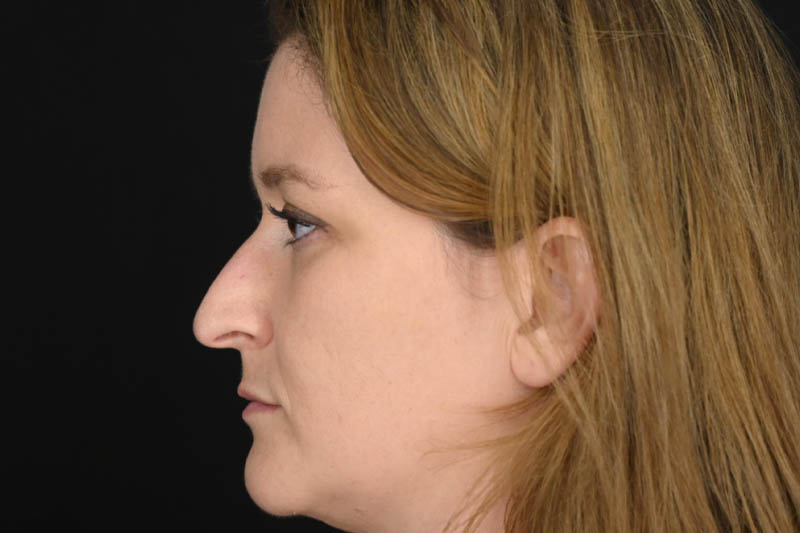 1_0016_Rhinoplasty 03 Before View 3.jpeg