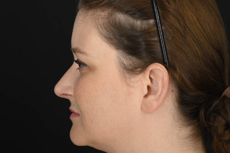 1_0017_Rhinoplasty 03 After View 3.png