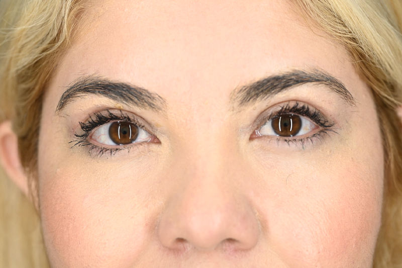 Blepharoplasty Upper 02 After.png