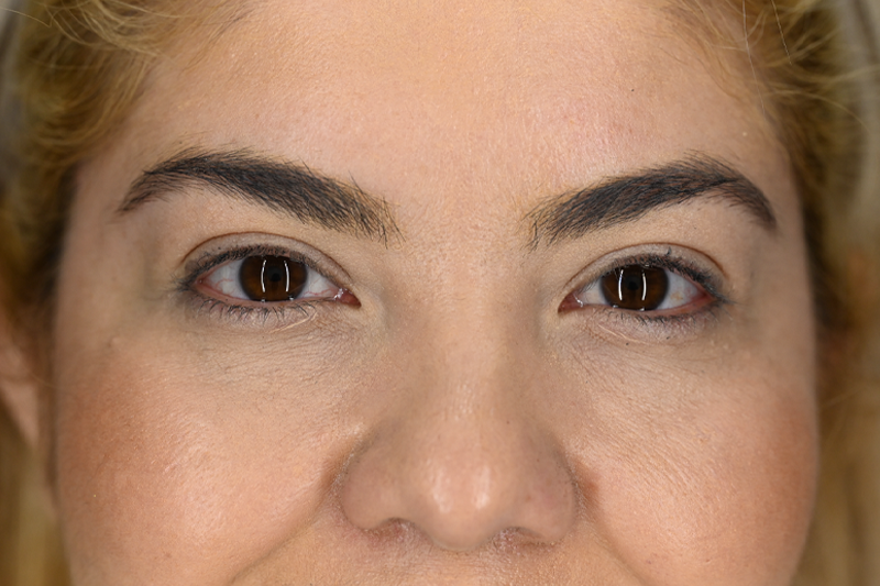 Blepharoplasty Upper 02 Before.png