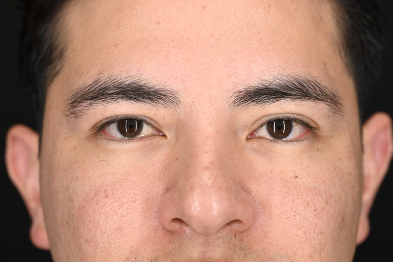 Blepharoplasty Upper 03 Before.png