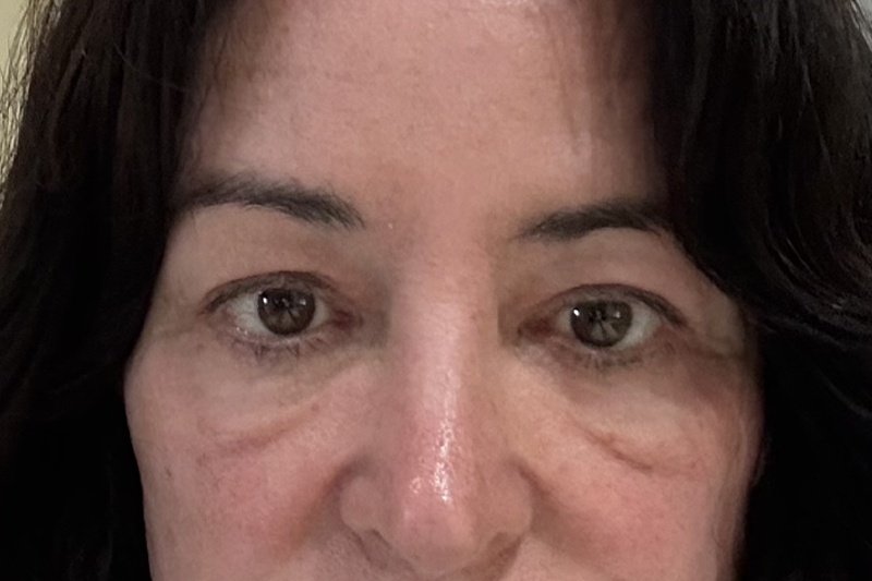 Blepharoplasty Upper 04 After 2 weeks.jpeg