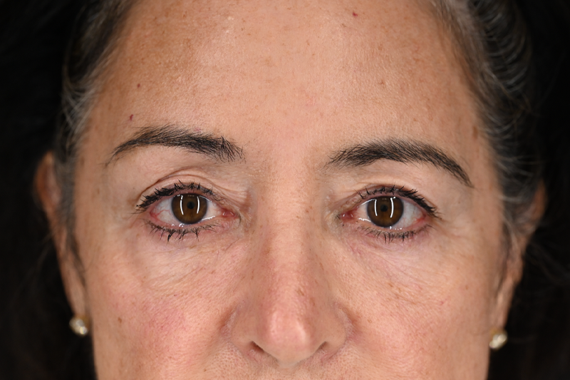 Blepharoplasty Upper 04 Before.png