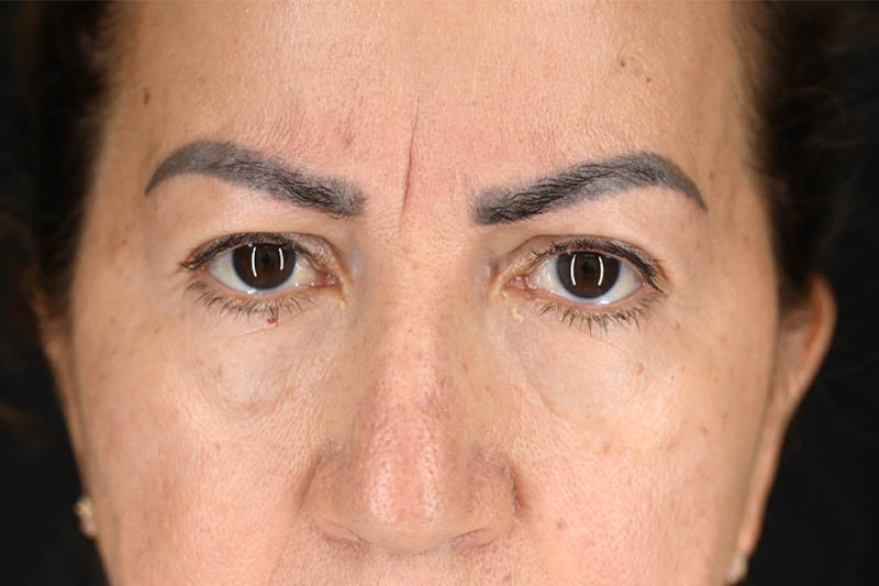 1_0000_Blepharoplasty Upper 05 Before.png