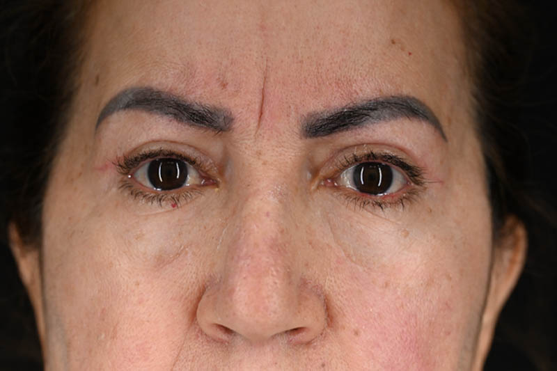 1_0001_Blepharoplasty Upper 05 After 3 months.png