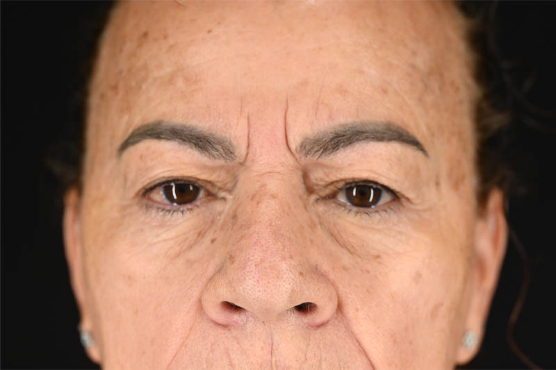 1_0002_Blepharoplasty Upper 06 Before.png