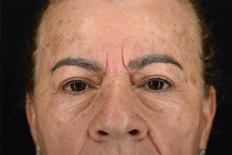 1_0003_Blepharoplasty Upper 06 After 3 months.png