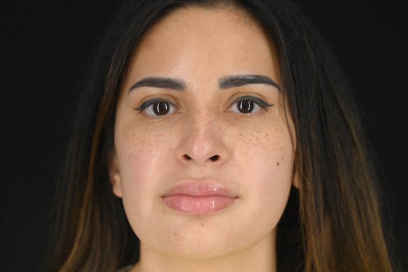 1_0004_Rhinoplasty 04 Before View 1.png