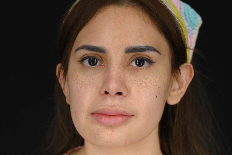 1_0005_Rhinoplasty 04 After View 1.png