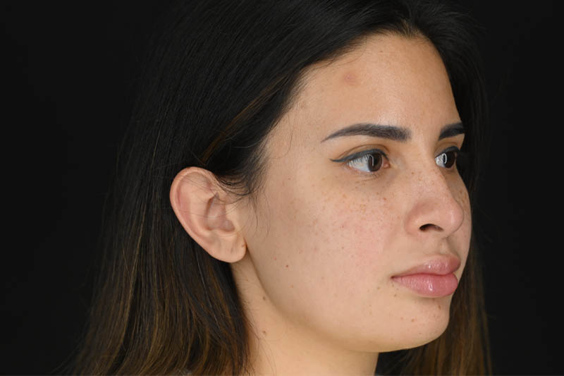 1_0006_Rhinoplasty 04 Before View 2.png