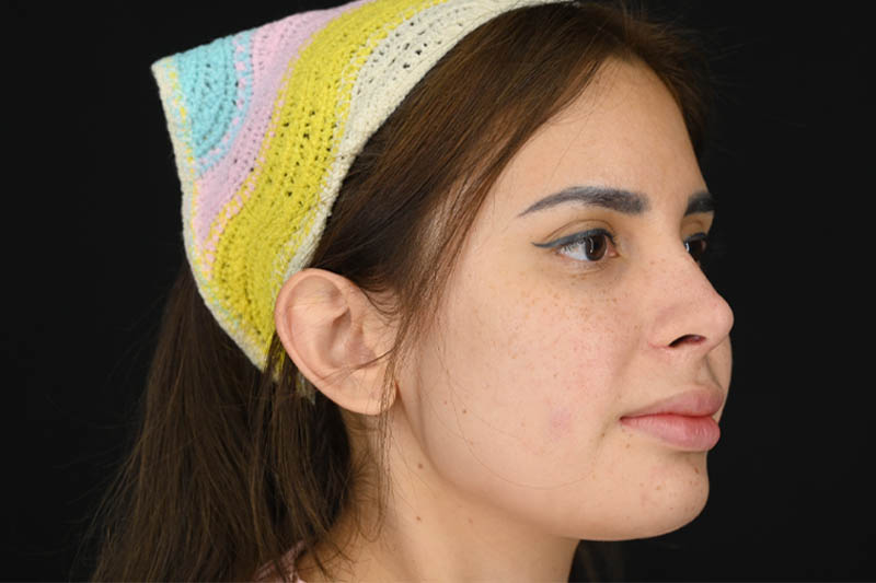 1_0007_Rhinoplasty 04 After View 2.png