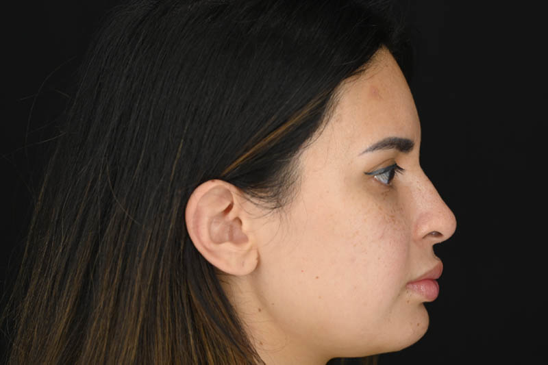 1_0008_Rhinoplasty 04 Before View 3.png