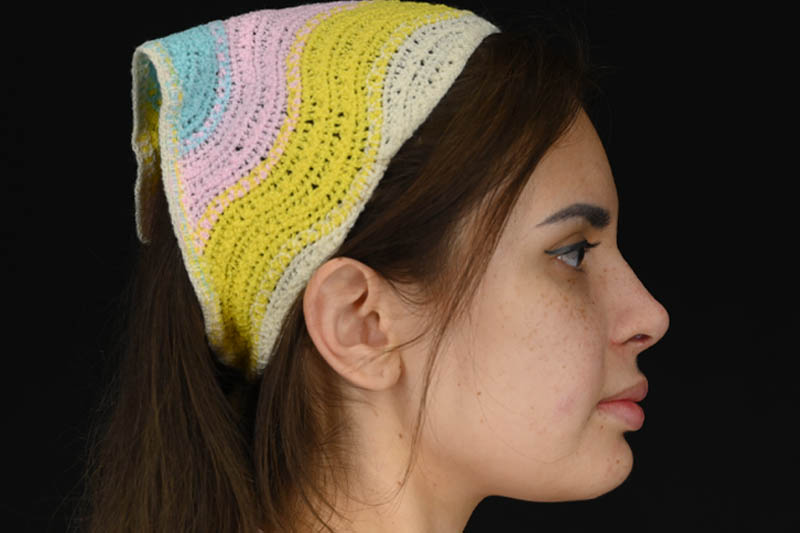 1_0009_Rhinoplasty 04 After View 3.png