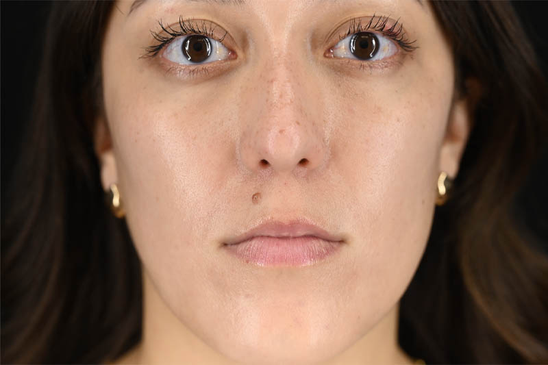 1_0010_Mole Removal 01 Before.png