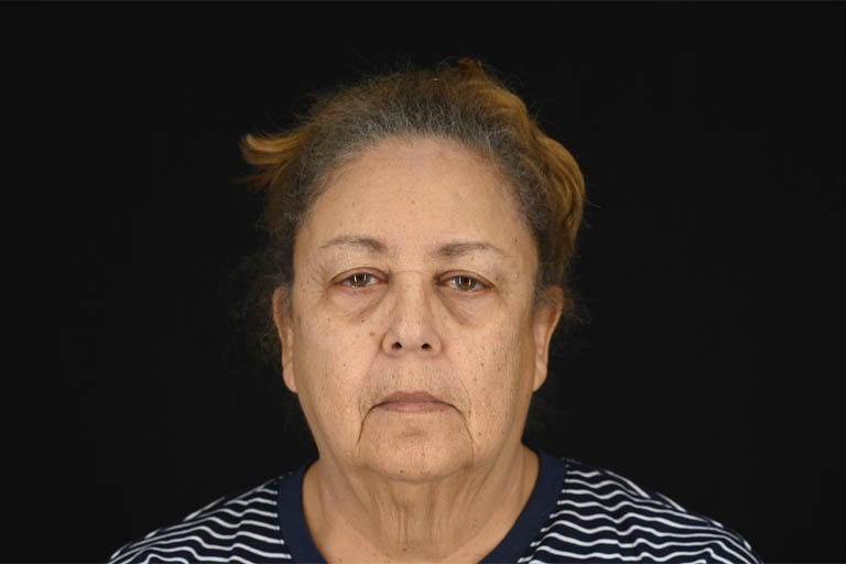 1_0000_Facelift 01 Before View 1.png