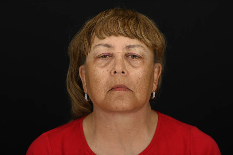 1_0001_Facelift 01 After View 1.png