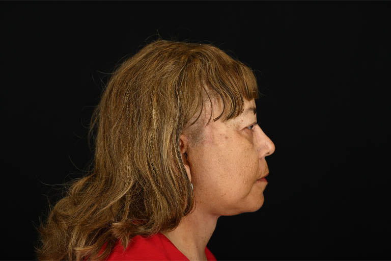 1_0005_Facelift 01 After View 3.png