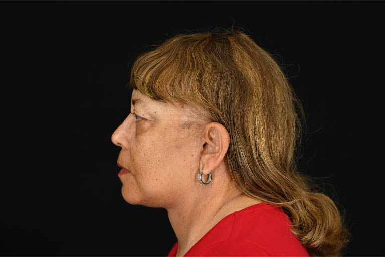 1_0009_Facelift 01 After View 5.png