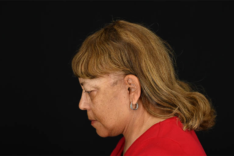 1_0011_Facelift 01 After View 6.png