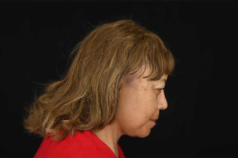 1_0013_Facelift 01 After View 7.png