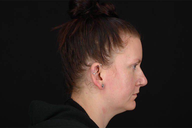 1_0018_Necklift 01 Before View 3.png