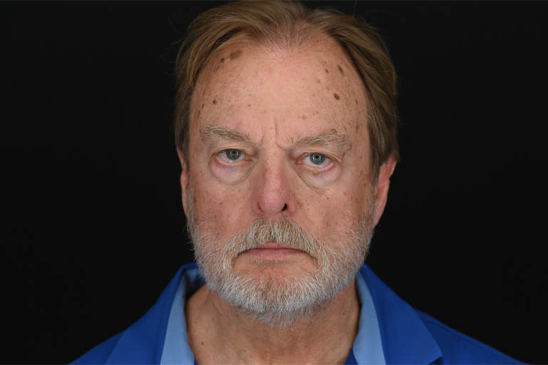 1_0025_Rhinoplasty 05 After View 1.png