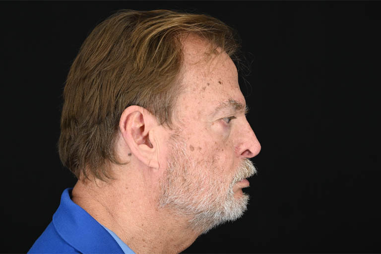 1_0027_Rhinoplasty 05 After View 2.png