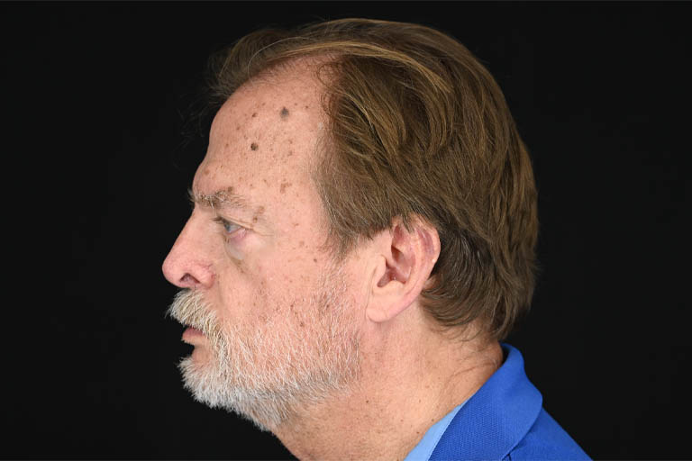 1_0029_Rhinoplasty 05 After View 3.png